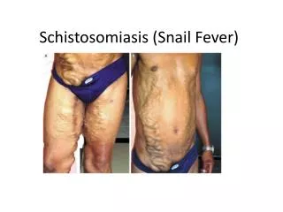 Schistosomiasis (Snail Fever)
