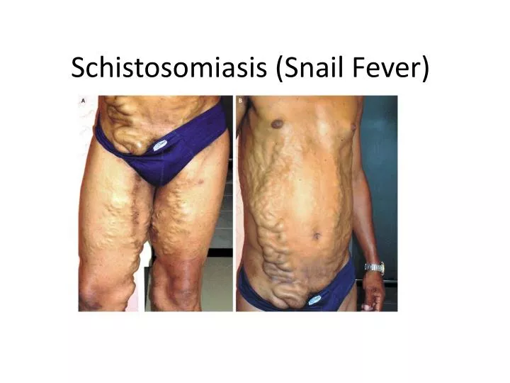 schistosomiasis snail fever