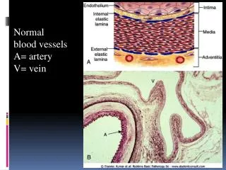 Normal blood vessels A= artery V= vein