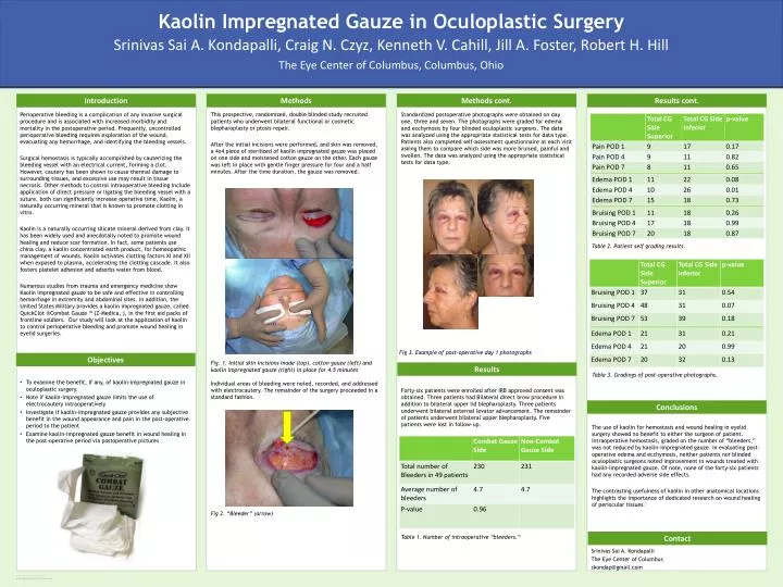 kaolin impregnated gauze in oculoplastic surgery