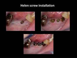 Helen screw installation