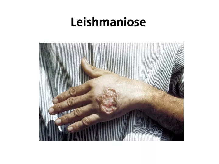 leishmaniose