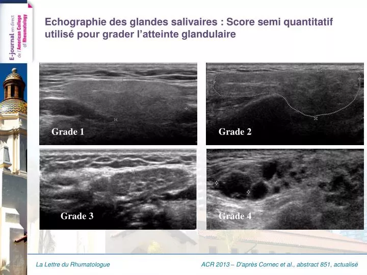 echographie des glandes salivaires score semi quantitatif utilis pour grader l atteinte glandulaire