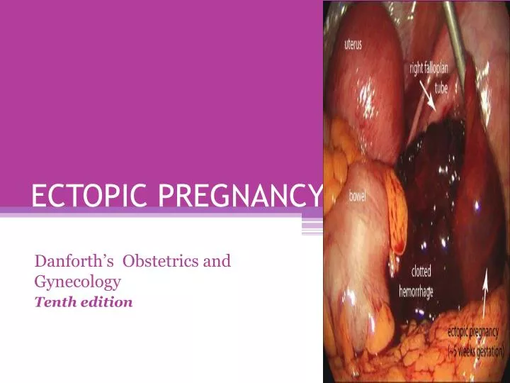 ectopic pregnancy