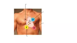 Tricuspid valve sounds typically heard in right sternal margin of 5th intercostal space