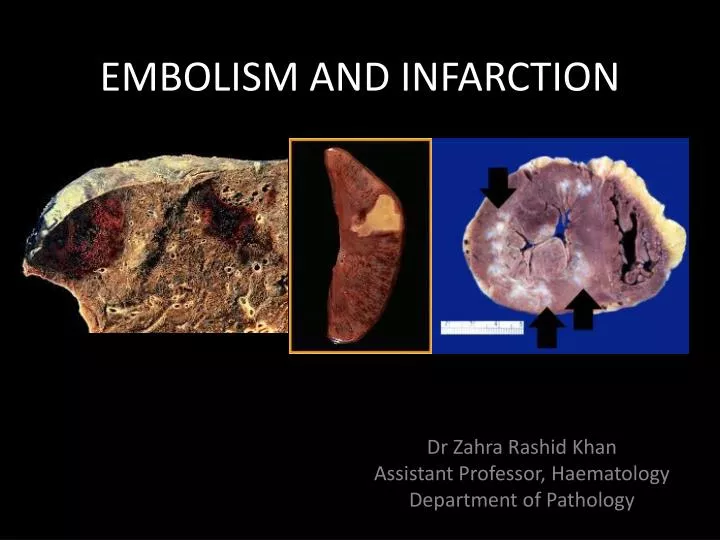 embolism and infarction