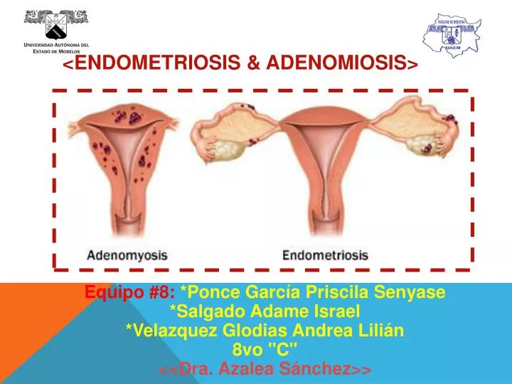 endometriosis adenomiosis