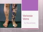 Varicose Veins - slide 1