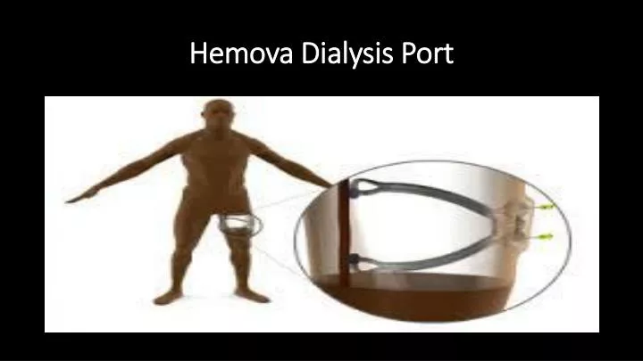 hemova dialysis port