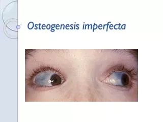 osteogenesis imperfecta