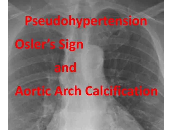 pseudohypertension osler s sign and aortic arch calcification