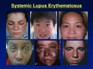 Systemic Lupus Erythematosus