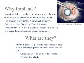 Why Implants?