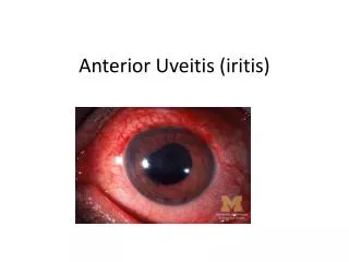 Anterior Uveitis ( iritis )