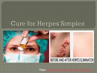 C ure for Herpes S implex