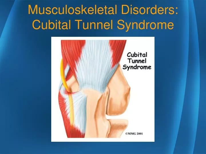 musculoskeletal disorders cubital tunnel syndrome