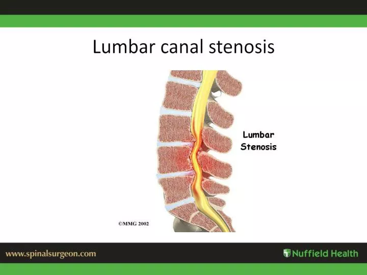 lumbar canal stenosis