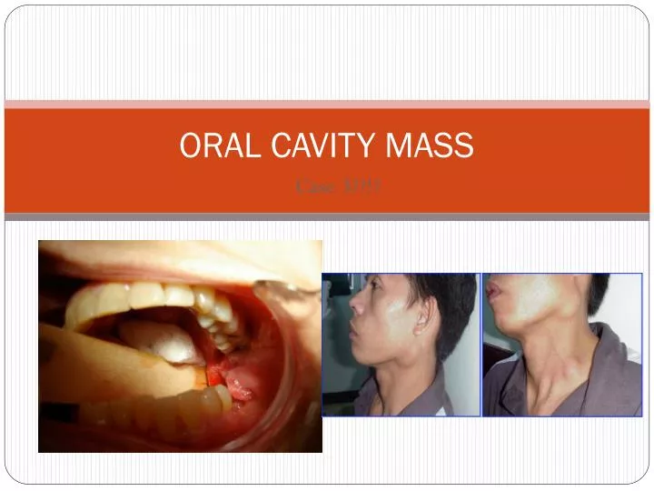 oral cavity mass