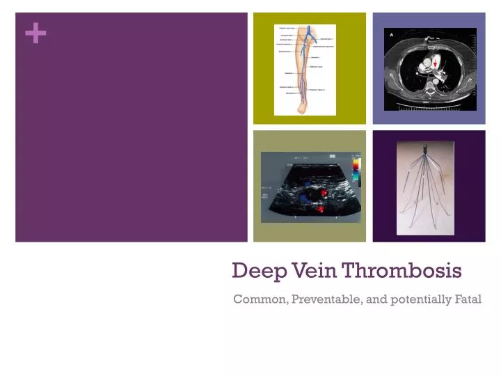 deep vein thrombosis