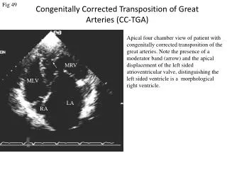 Congenitally Corrected Transposition of Great Arteries (CC-TGA)