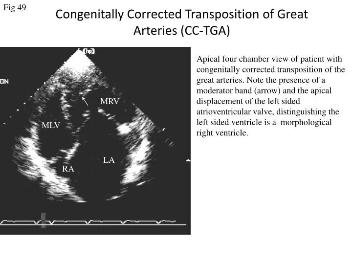 congenitally corrected transposition of great arteries cc tga