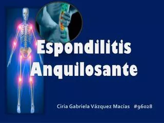 espondilitis anquilosante