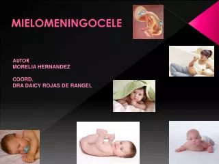 mielomeningocele