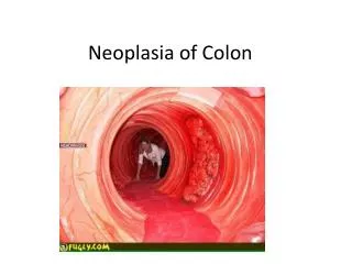 Neoplasia of Colon