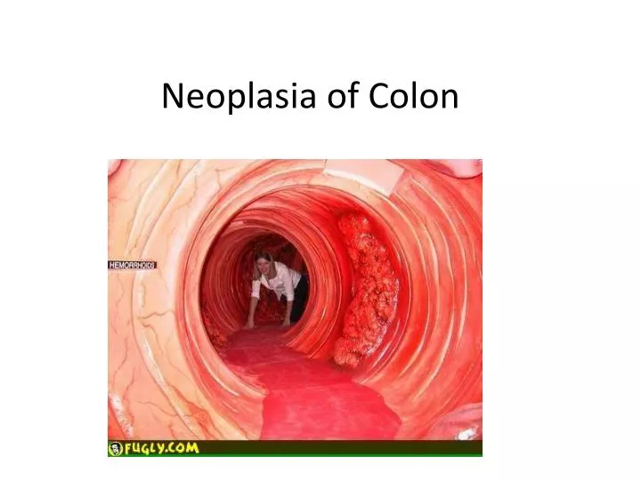 neoplasia of colon