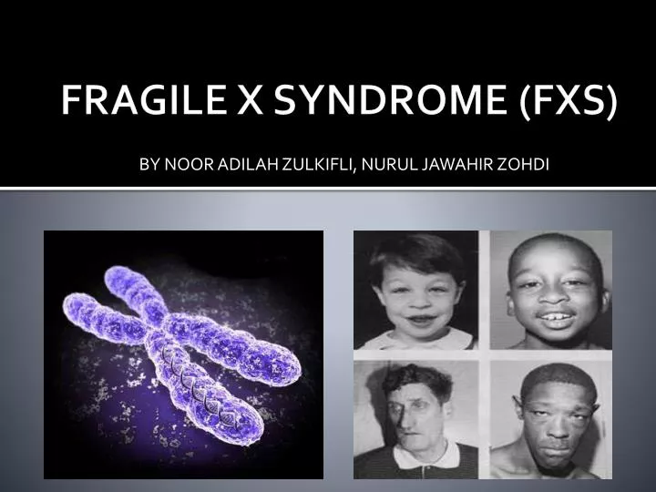 fragile x syndrome fxs