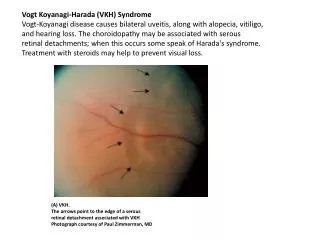 Vogt Koyanagi -Harada (VKH) Syndrome