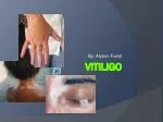 Vitiligo - slide 1