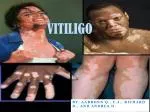 VITILIGO - slide 1