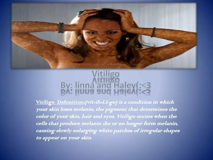 vitiligo by linna and haley 3