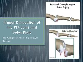 Finger Dislocation of the PIP Joint and Volar Plate