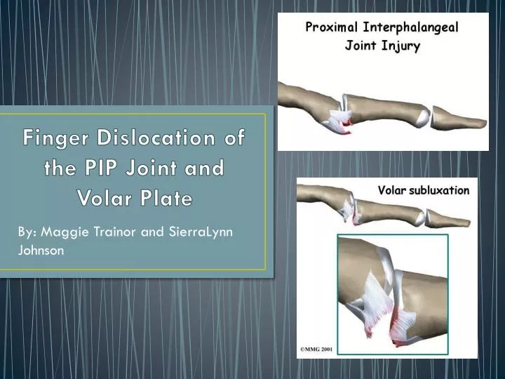 finger dislocation of the pip joint and volar plate