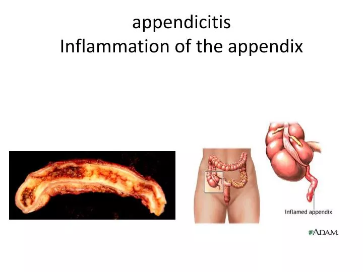 a ppendicitis inflammation of the appendix