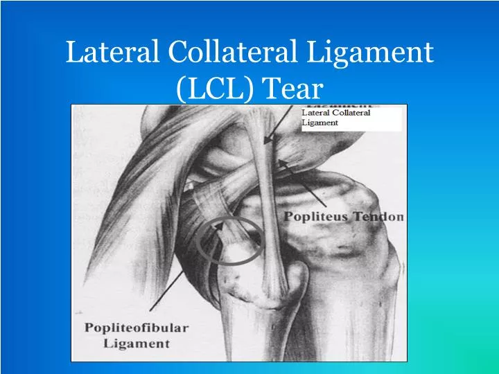 lateral collateral ligament lcl tear