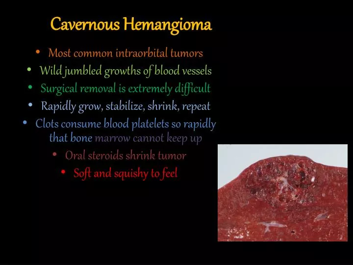 cavernous hemangioma