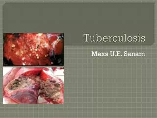 Tuberculosis