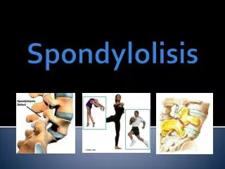 Spondylolisis