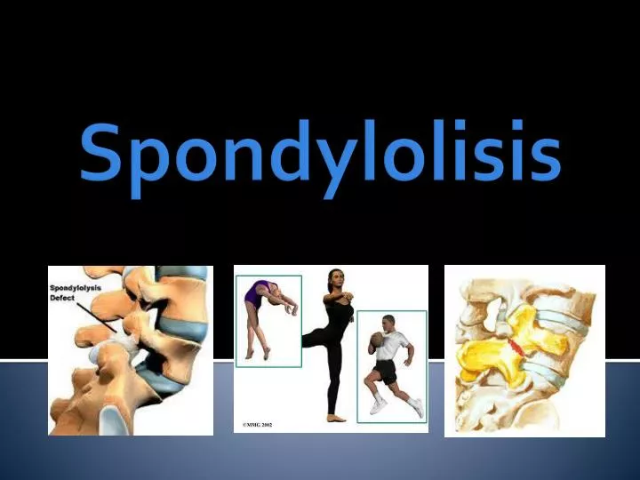 spondylolisis