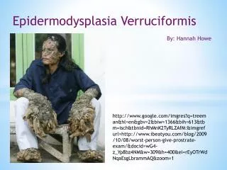 Epidermodysplasia Verruciformis