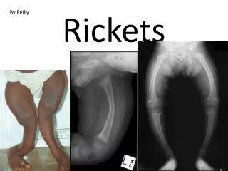 Rickets