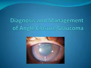 Diagnosis and Management of Angle Closure Glaucoma
