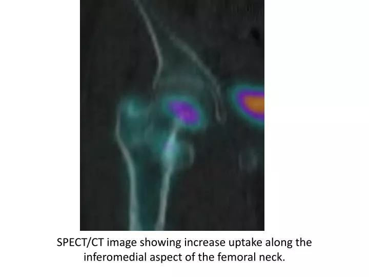 spect ct image showing increase uptake along the inferomedial aspect of the femoral neck