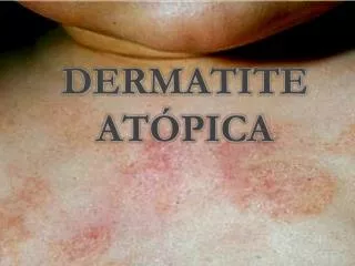 Ppt Dermatite Allergica Da Contatto Powerpoint Presentation Free