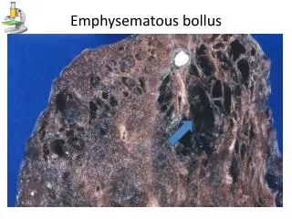 Emphysematous bollus