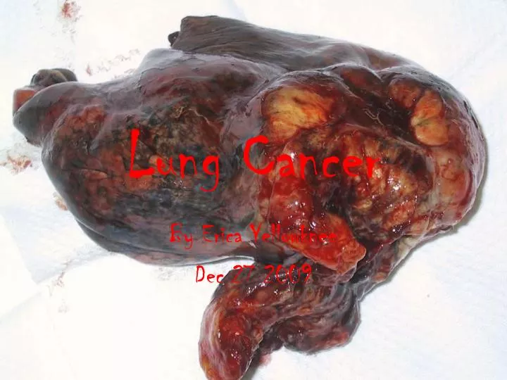 lung cancer