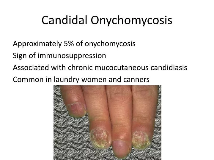 candidal onychomycosis